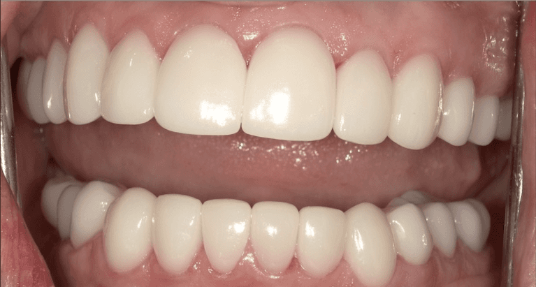 Veneers-After-Image