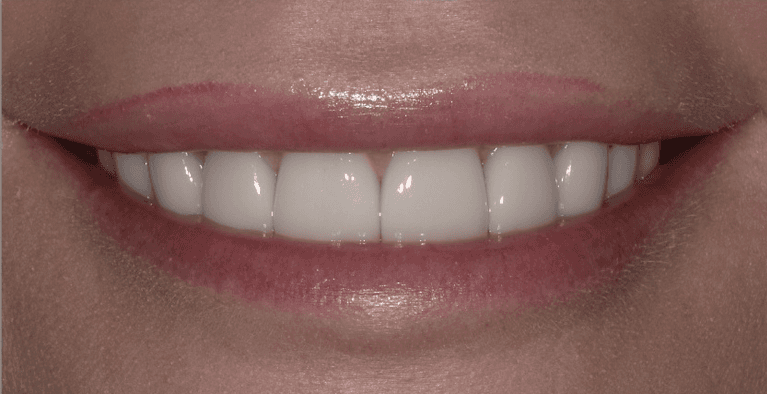 Veneers in Scottsdale- after photo