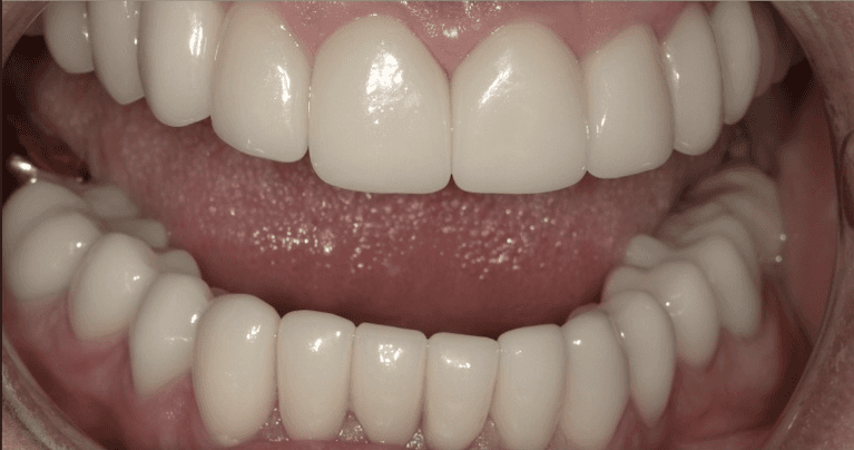 Scottsdale-Full-Smile-Makeover-After-Image