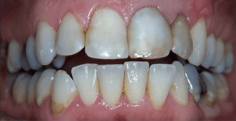 Smile-Makeover-in-Scottsdale-Before-Image