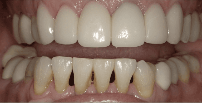 Veneers in Scottsdale- before photo
