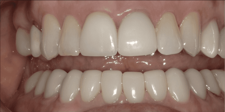 Veneers in Scottsdale- before photo