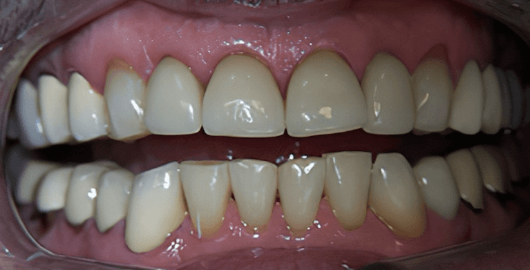 dental crowns in scottsdale- before photo