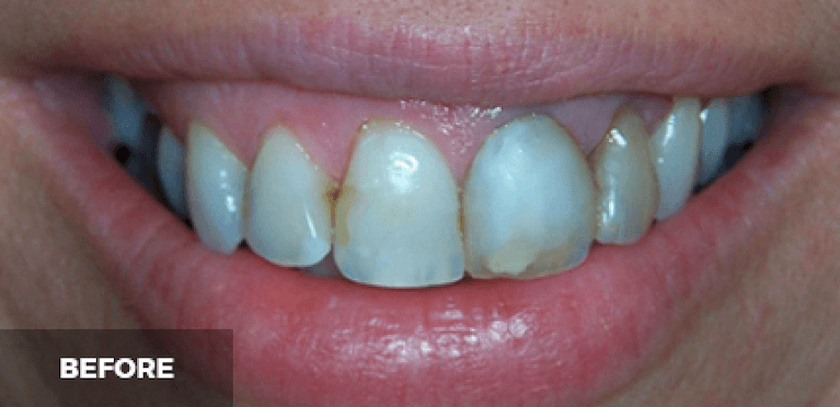 smile makeover in scottsdale- before photo