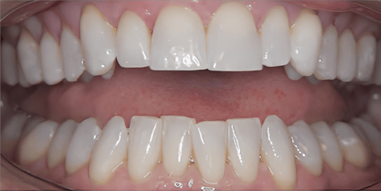 Veneers in Scottsdale- before photo