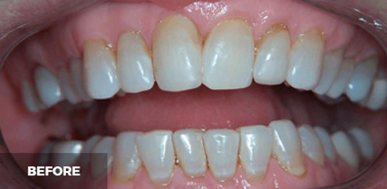 dental crowns in scottsdale- before photo