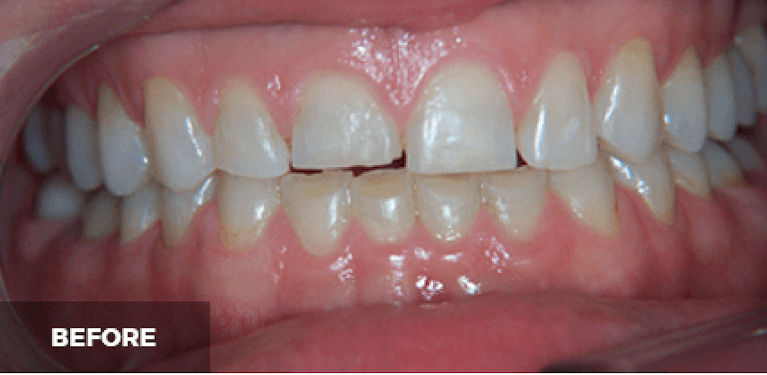 smile makeover in scottsdale- before photo