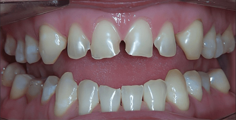 dental crowns in scottsdale- before photo