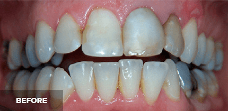 smile makeover in scottsdale- before photo