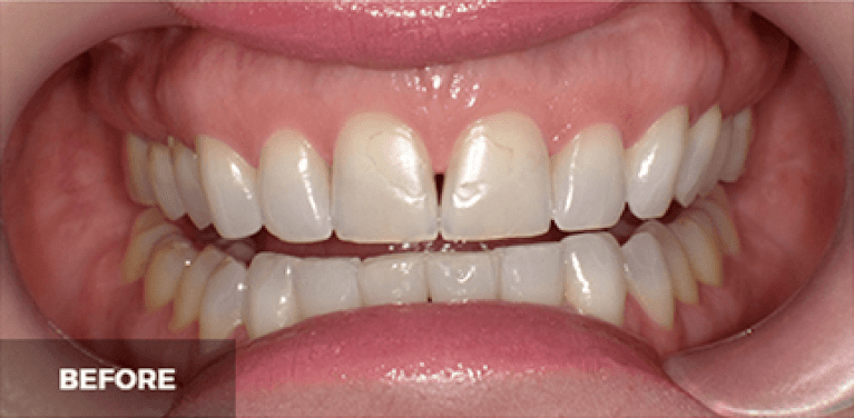 Veneers in Scottsdale- before photo