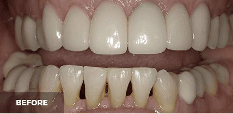 dental crowns in scottsdale- before photo