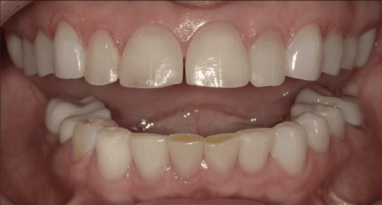 Veneers-Before-Image