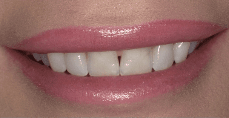 Veneers in Scottsdale- before photo