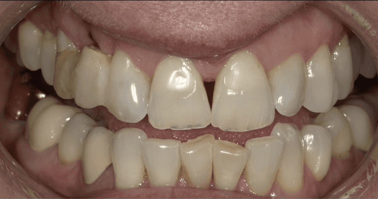 Scottsdale-Full-Smile-Makeover-Before-Image